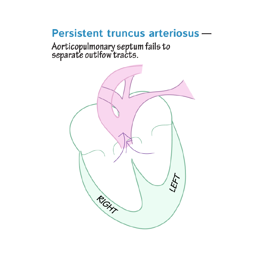Congenital Cardiac Right to Left Shunts