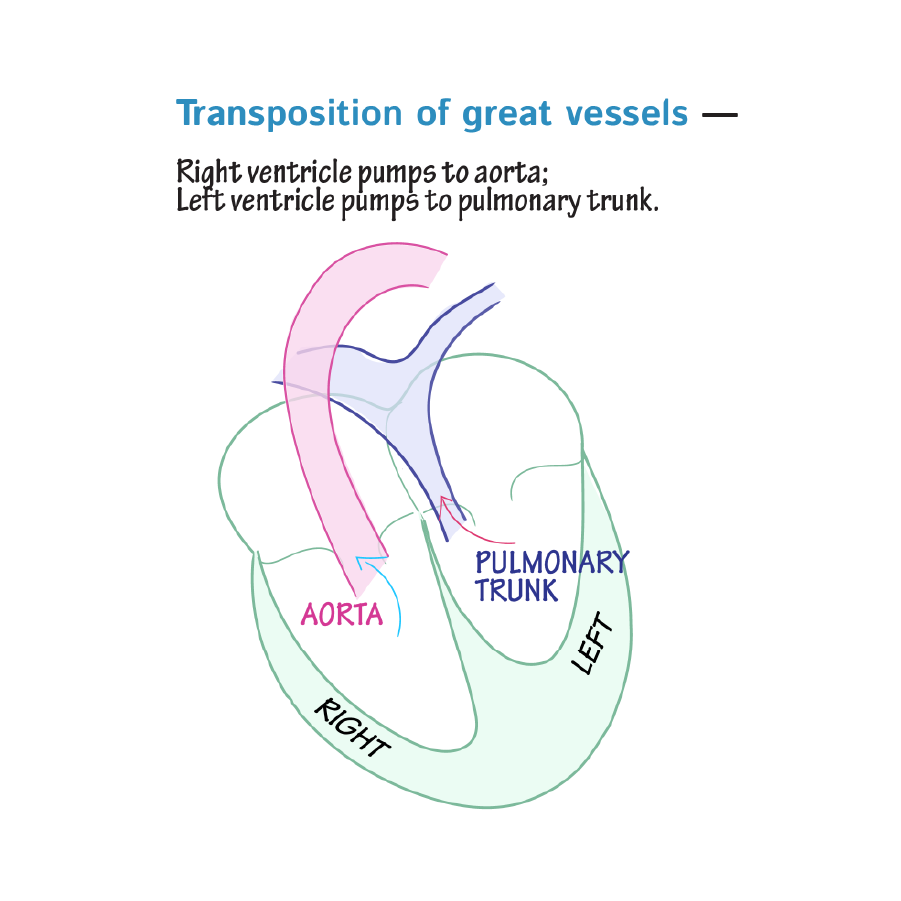 Congenital Cardiac Right to Left Shunts
