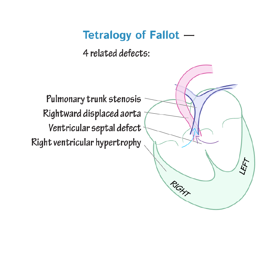 Congenital Cardiac Right to Left Shunts