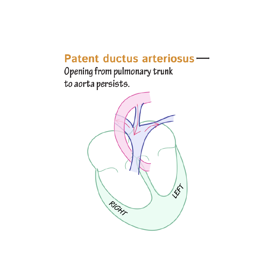 Congenital Cardiac Left to Right Shunts