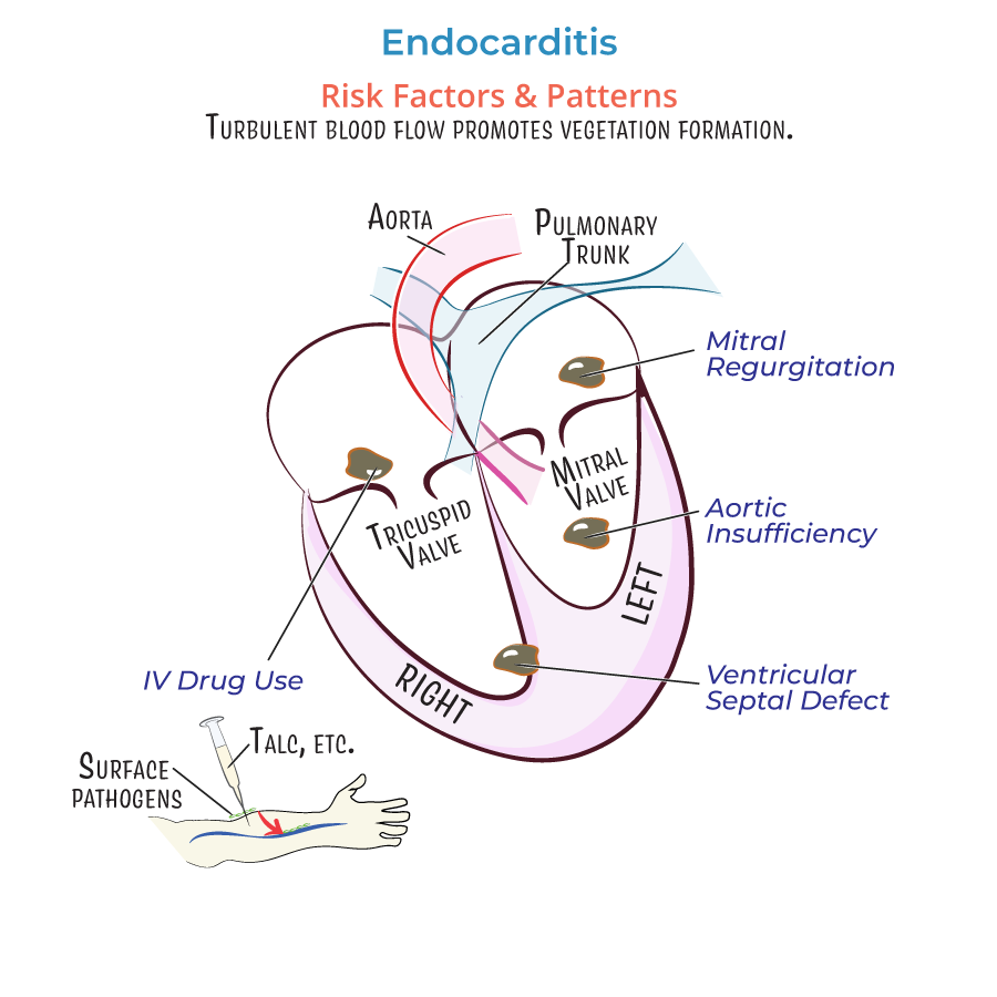 Endocarditis risk factors and patterns