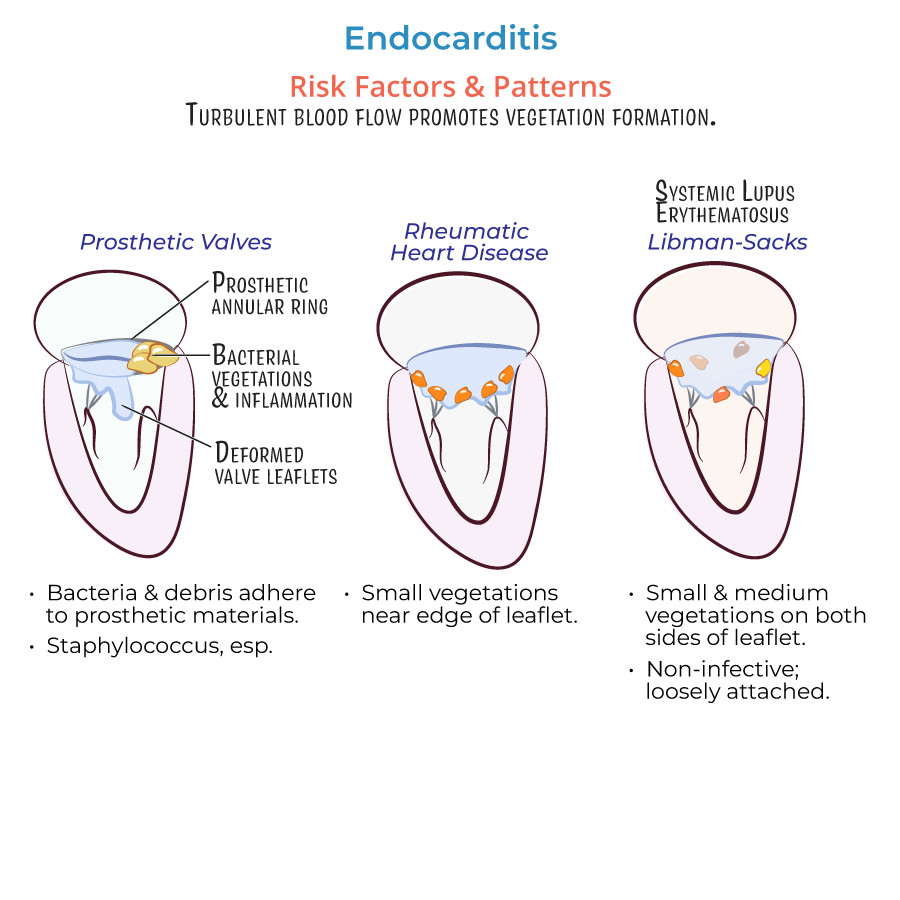 Endocarditis risk factors