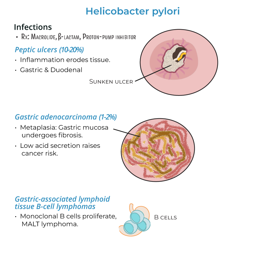 Helicobacter pylori. Peptic ulcers, gastric adenocarcinoma, gastric cancer