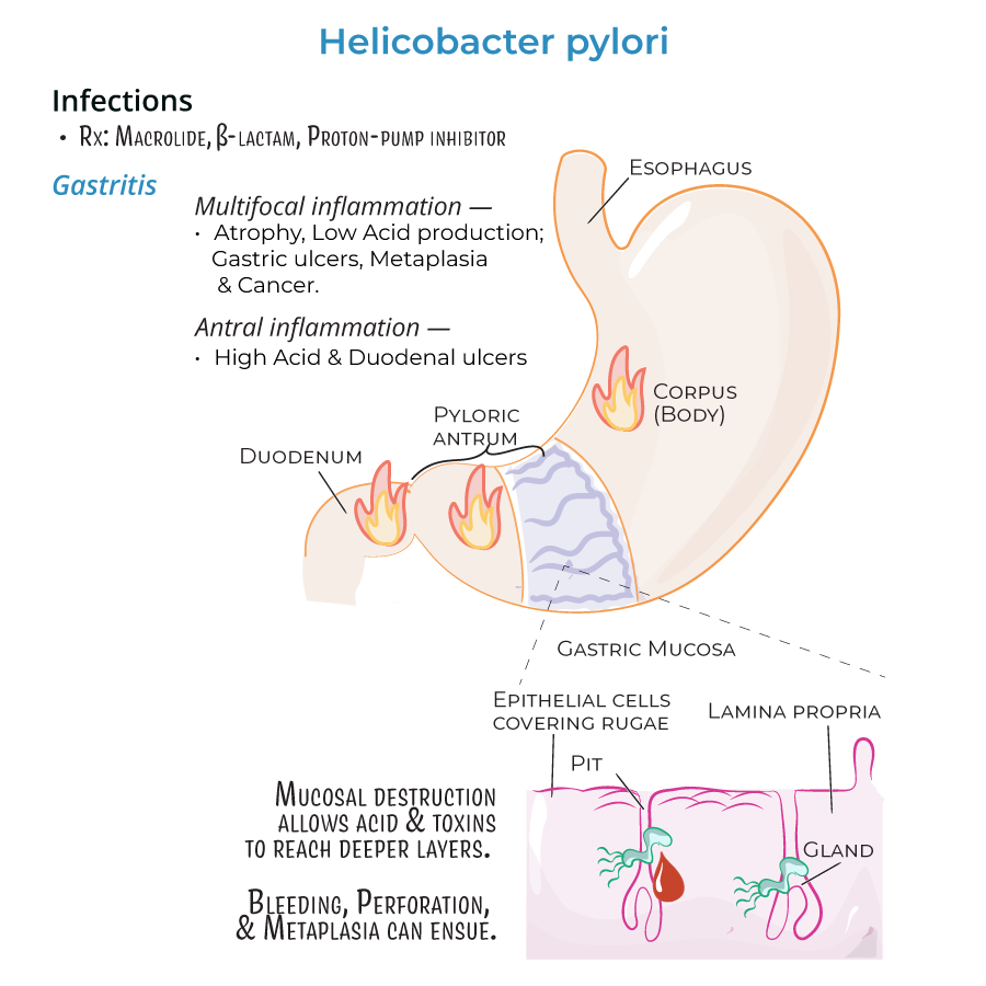 Helicobacter pylori gastritis