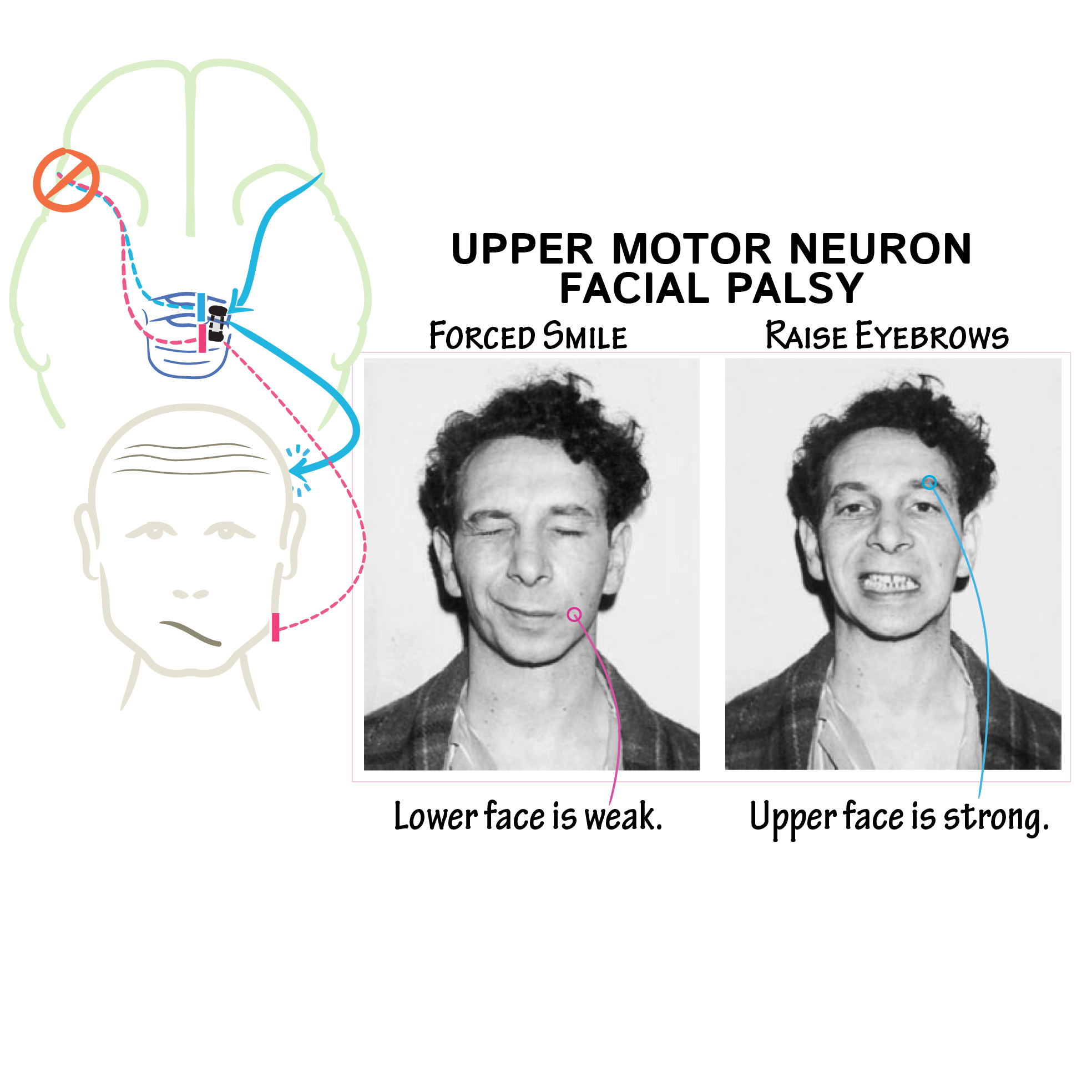Neuroscience Fundamentals: Facial Innervation (Stroke vs Bell's Palsy ...