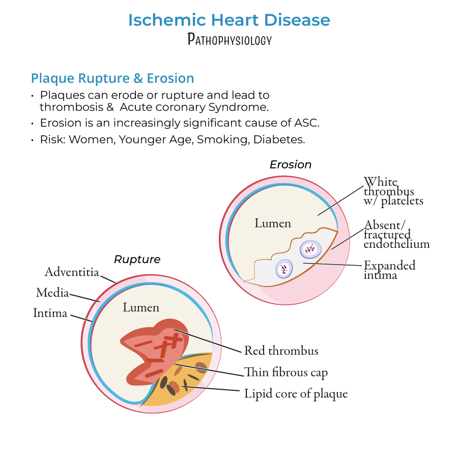 arterial plaque rupture, arterial plaque erosion, coronary artery disease, ischemic heart disease