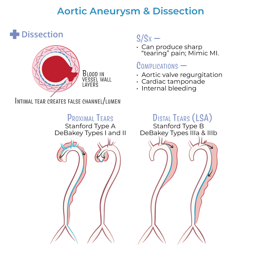 aortic dissection