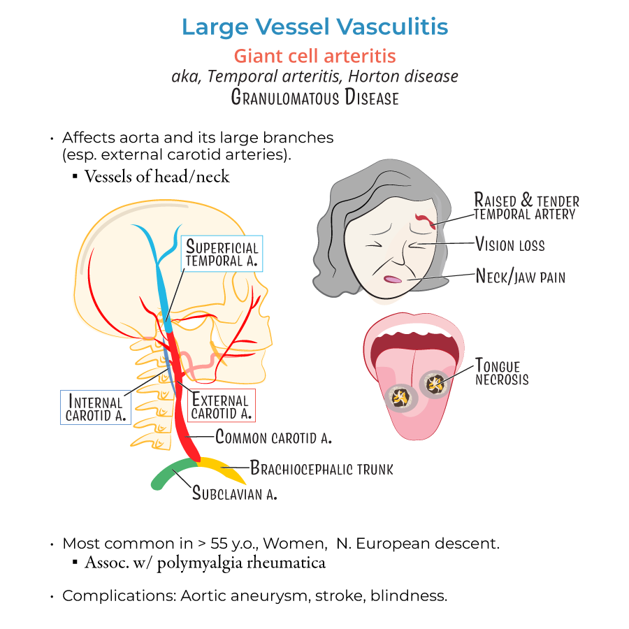 Vasculitis, giant cell artertitis