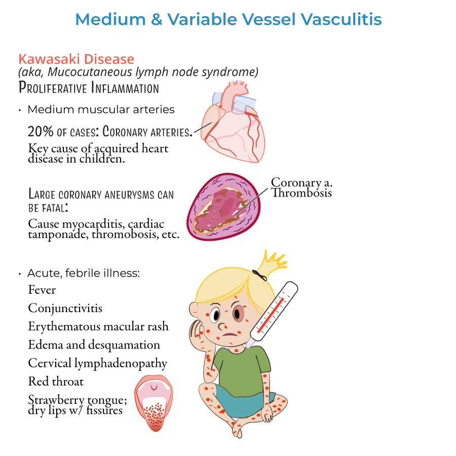 kawasaki disease