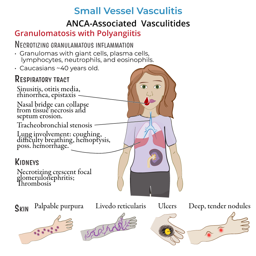 ANCA-associated vasculitis
