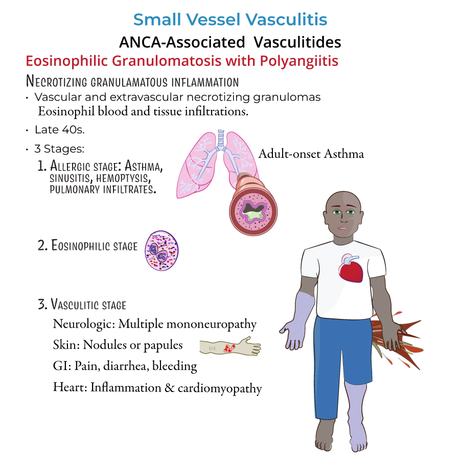 ANCA-associated vasculitis