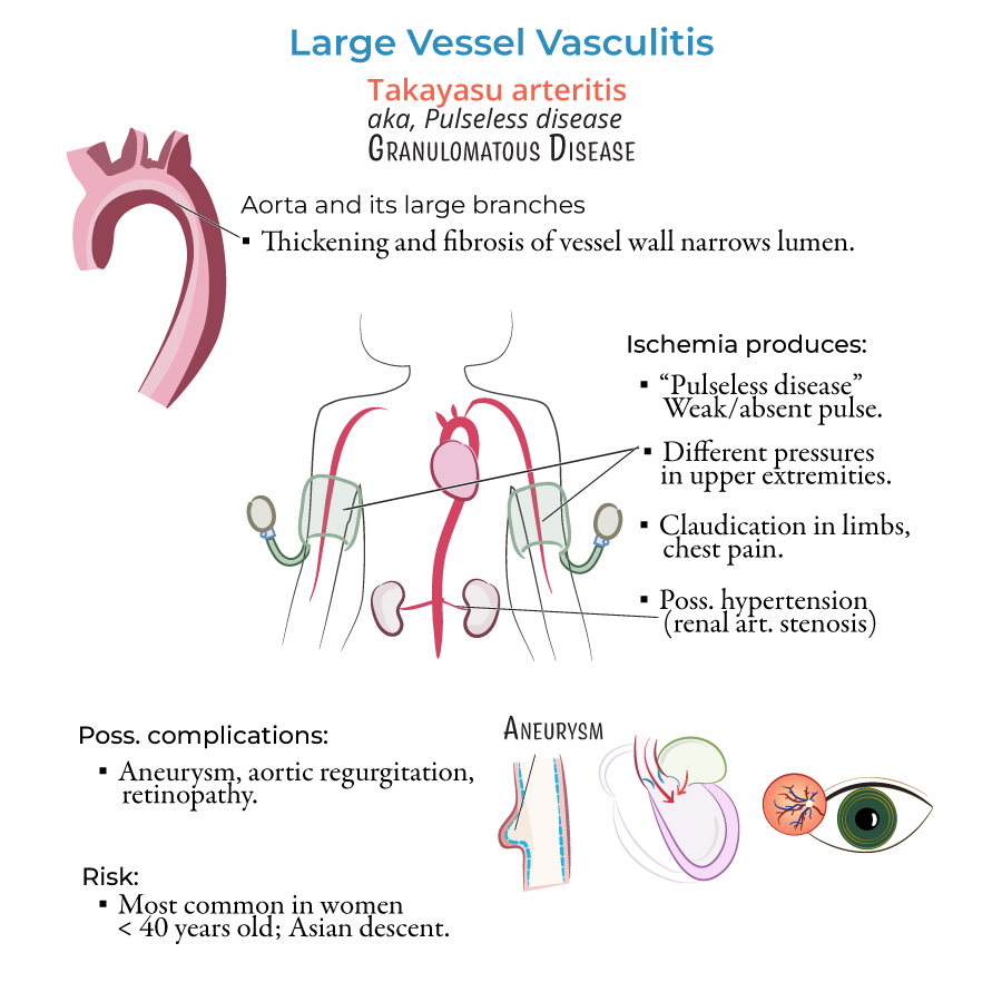 Takayasu arteritis