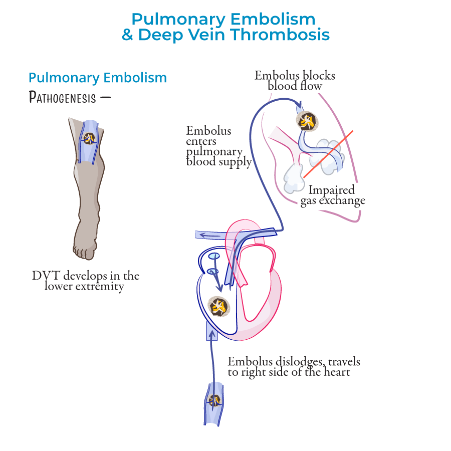 Pulmonary Embolism & Deep Vein Thrombosis