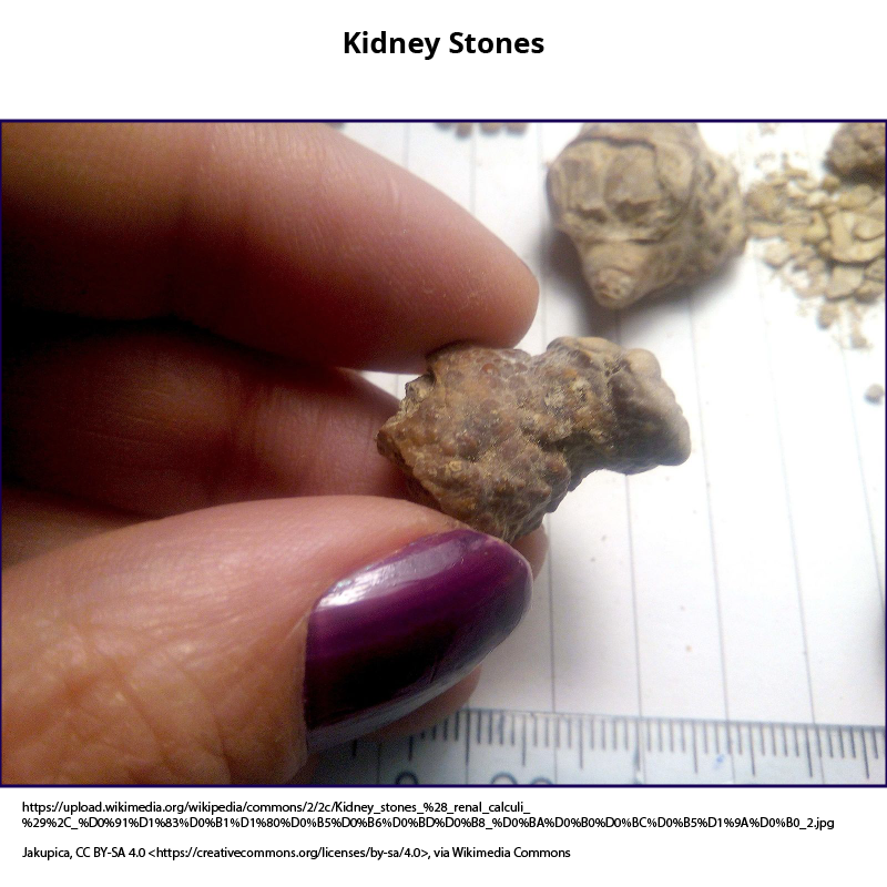 Kidney Stones (aka, renal calculus)