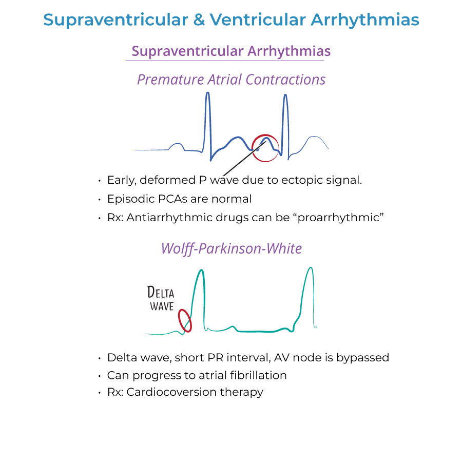 Supraventricular and Ventricular Arrhythmias