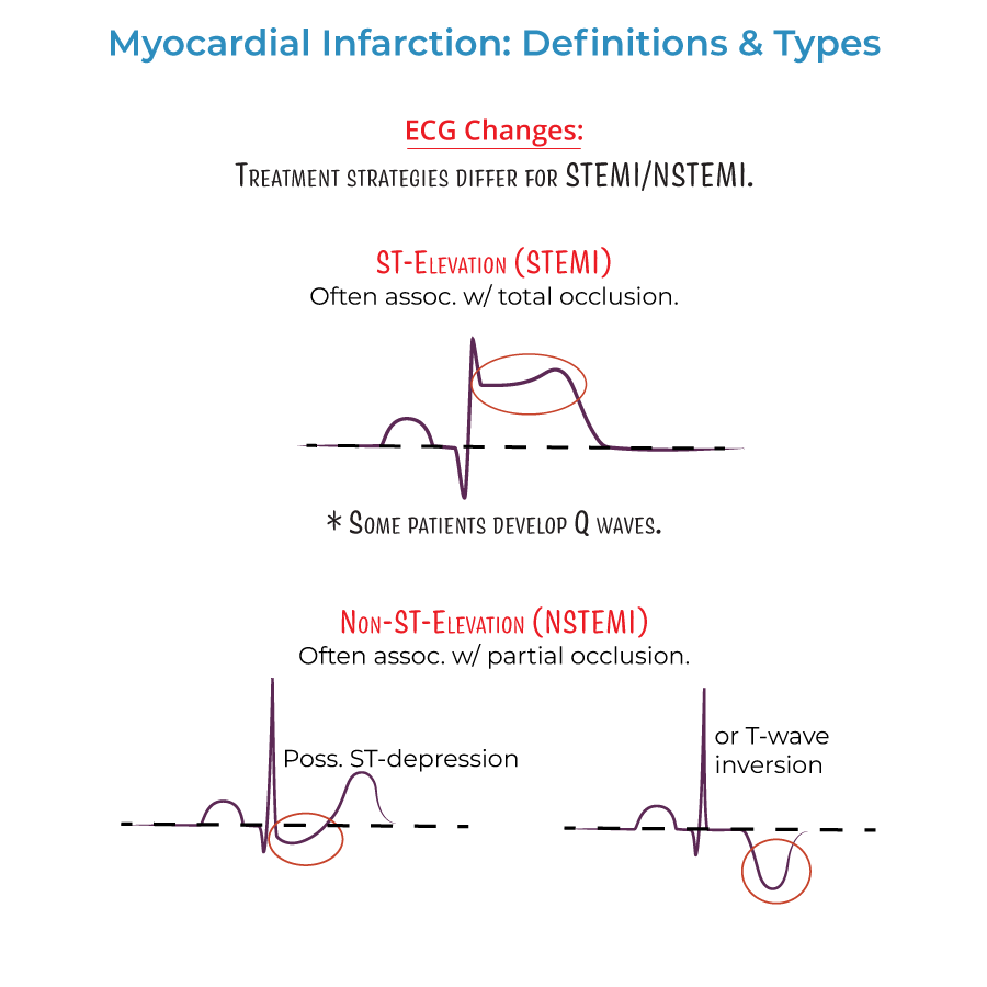 myocardial infarction types