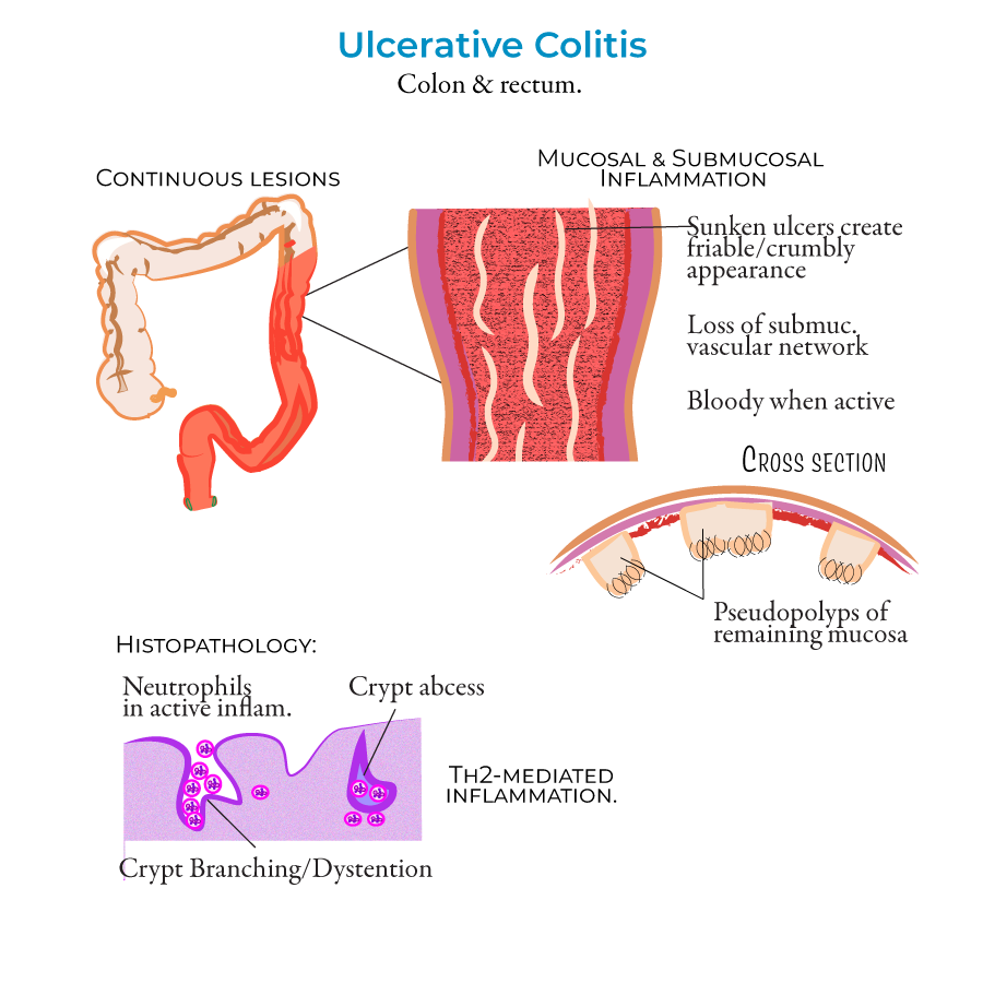 Inflammatory Bowel Disease, ulcerative colitis