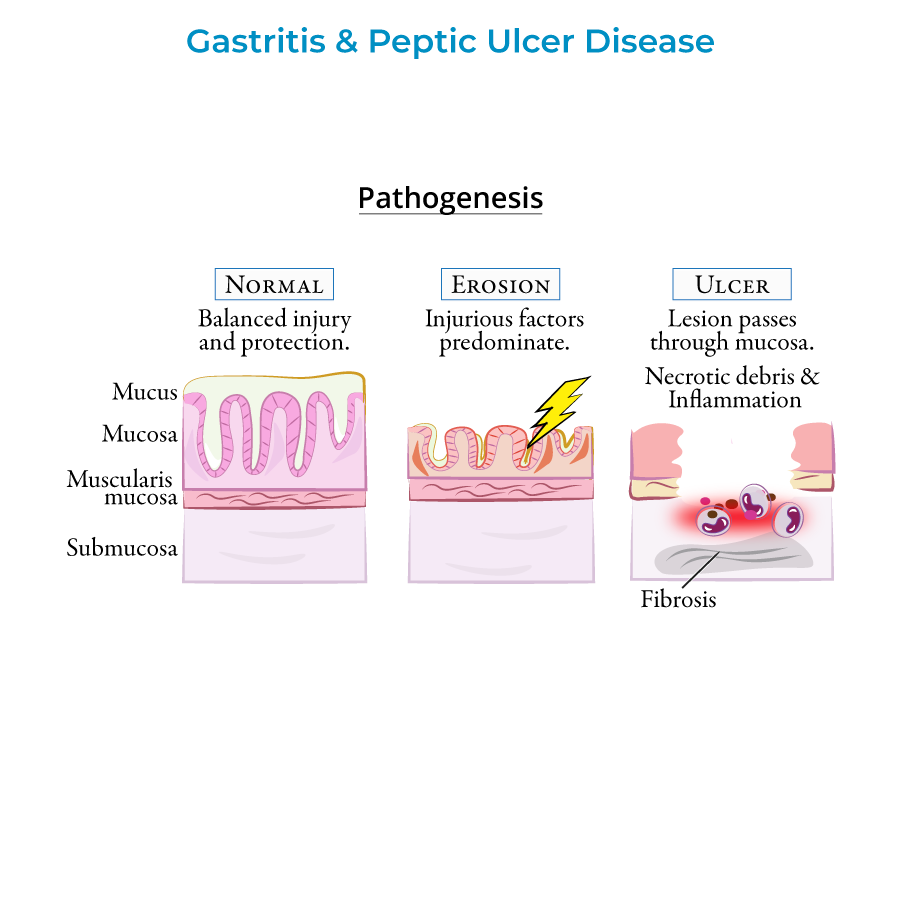 gastritis & peptic ulcer disease