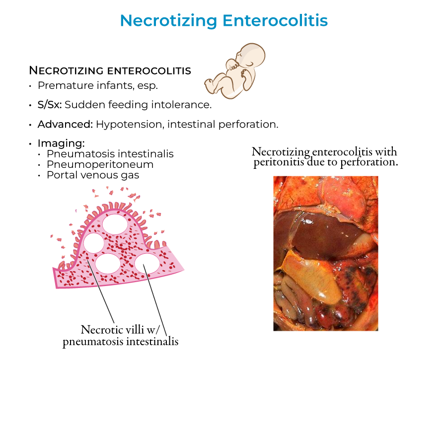 necrotizing enterocolitis