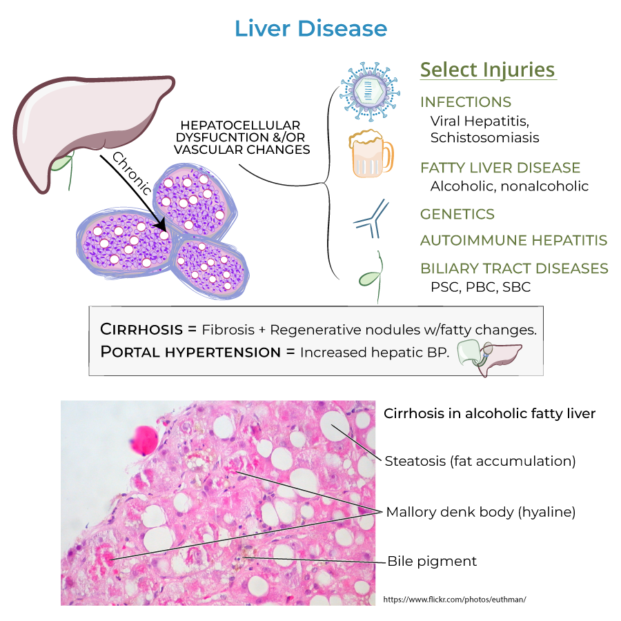 liver disease cirrhosis portal hypertension