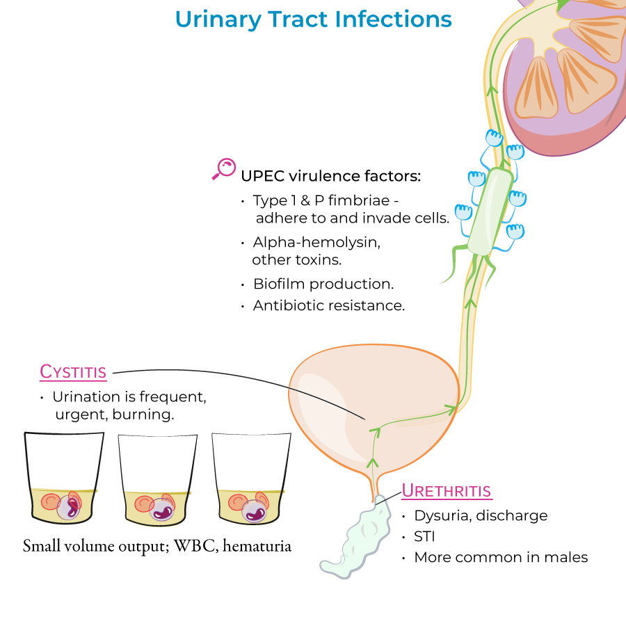 Urinary Tract Infections, cystitis, urethritis, UPEC