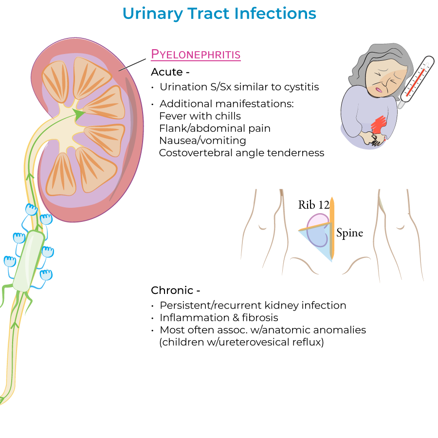 Urinary Tract Infections, pyelonephritis 