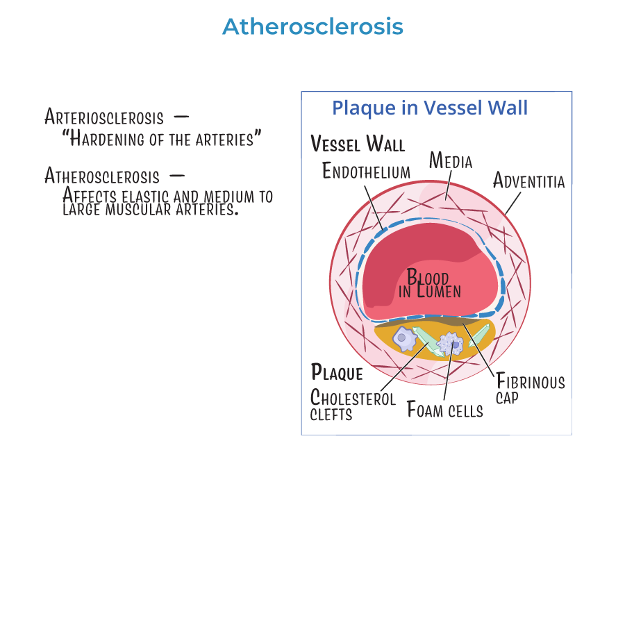 atherosclerosis vessel walls