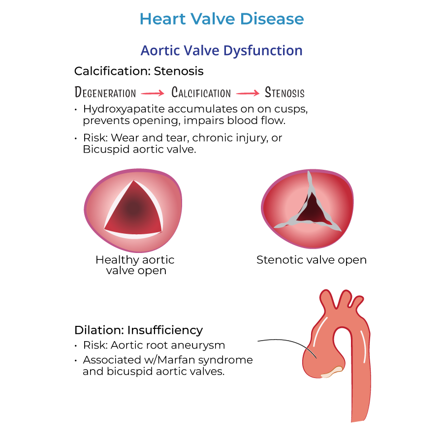 aortic valve dysfunction, aortic valve stenosis, aortic valve 