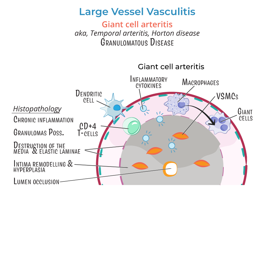 Vasculitis, giant cell arteritis