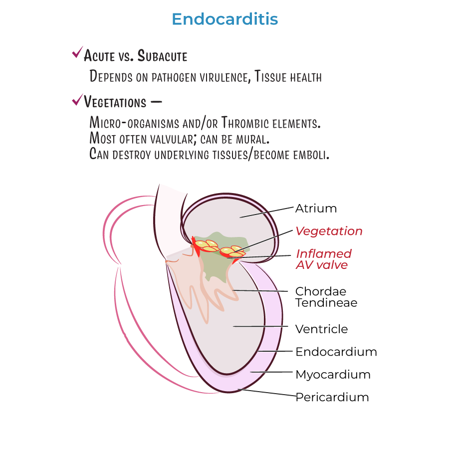 Endocarditis