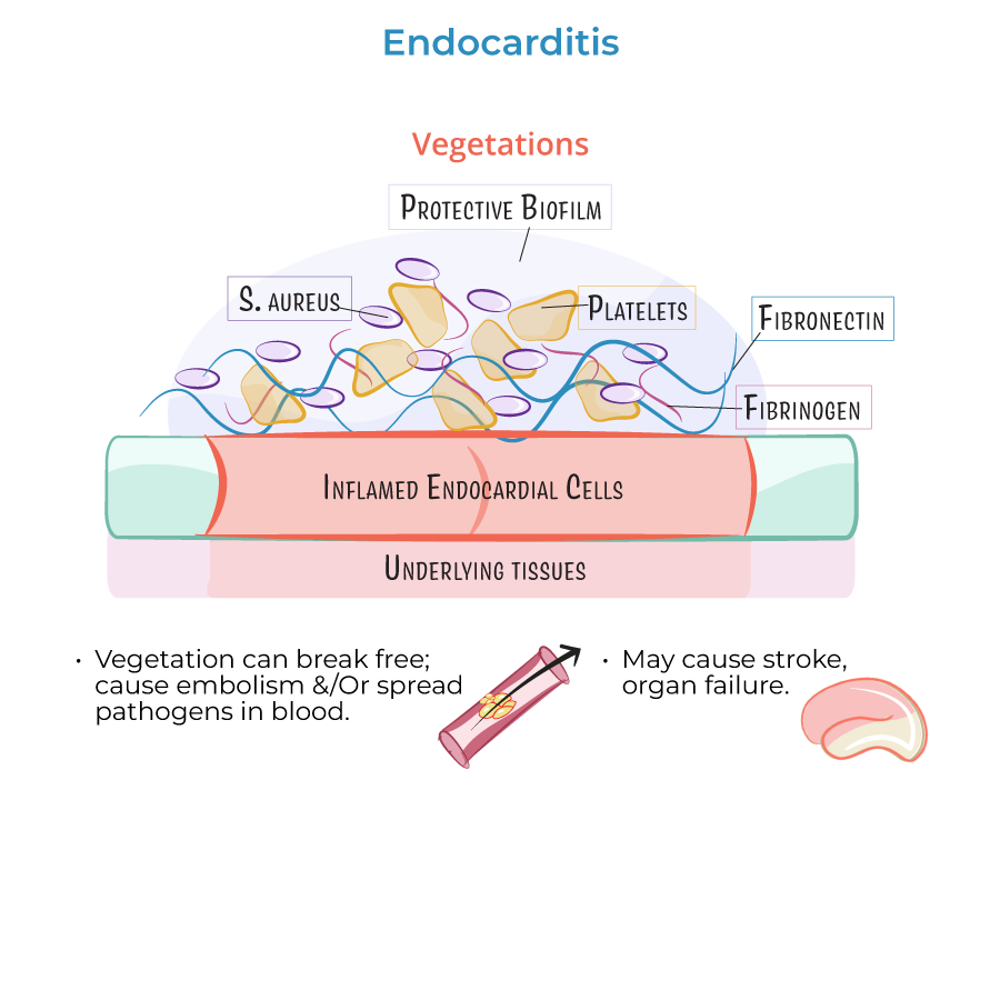 Endocarditis vegetations