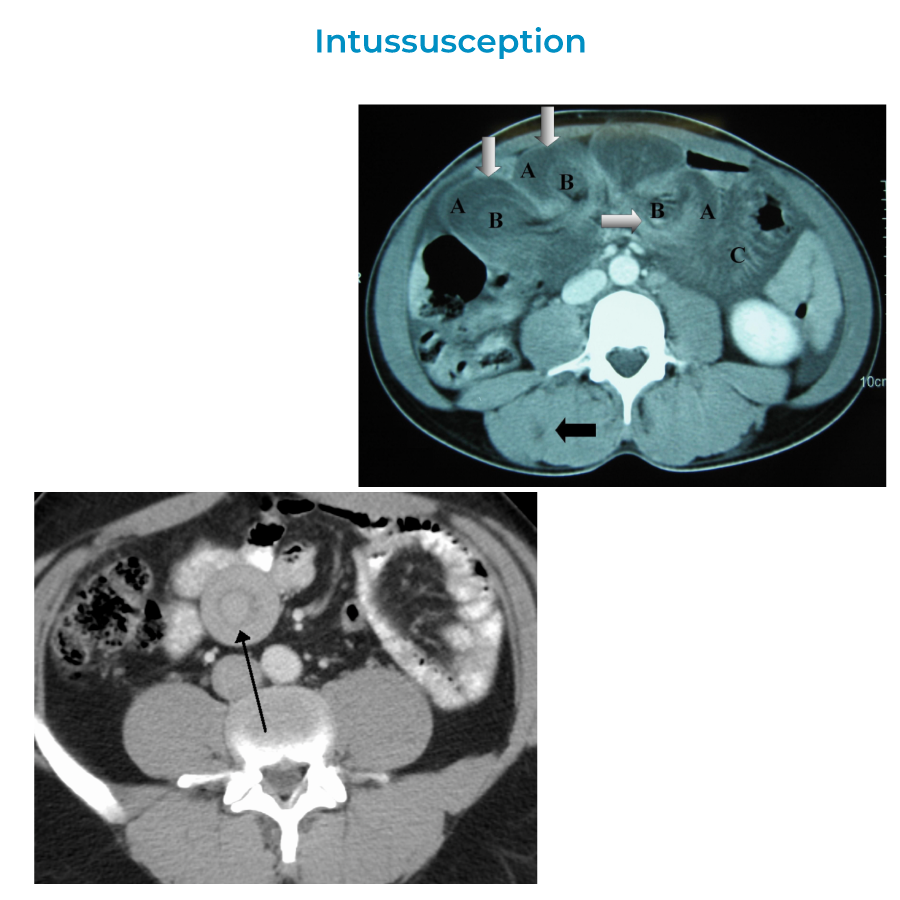 Intussusception