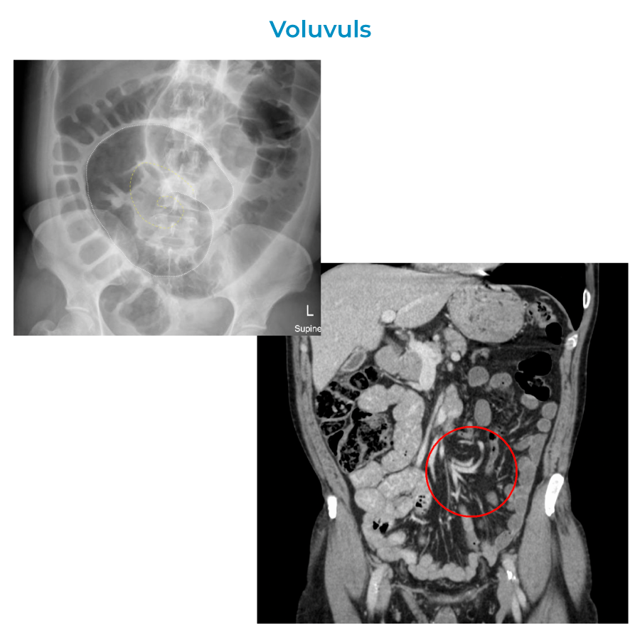 Volvulus