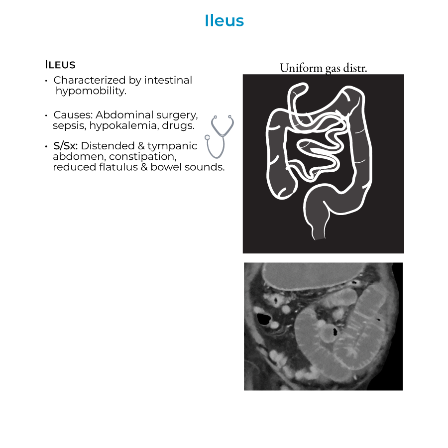 Ileus