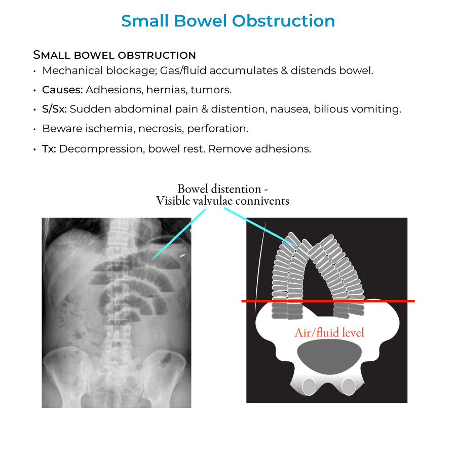 small bowel obstruction