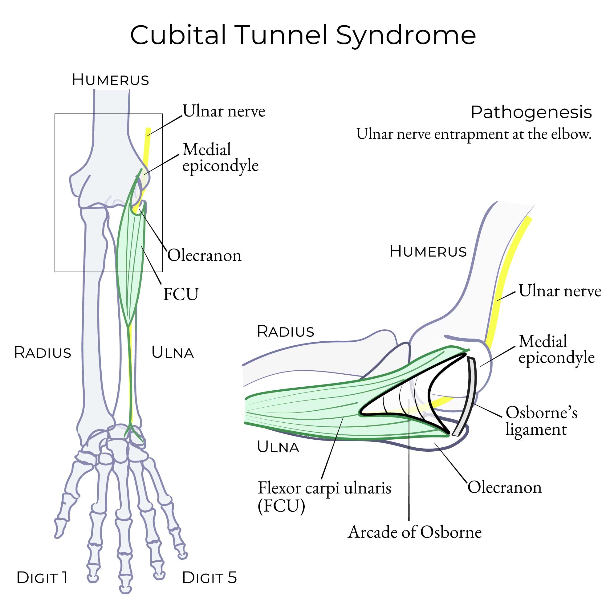 Cubital tunnel syndrome ulnar nerve arcade of Osborne
