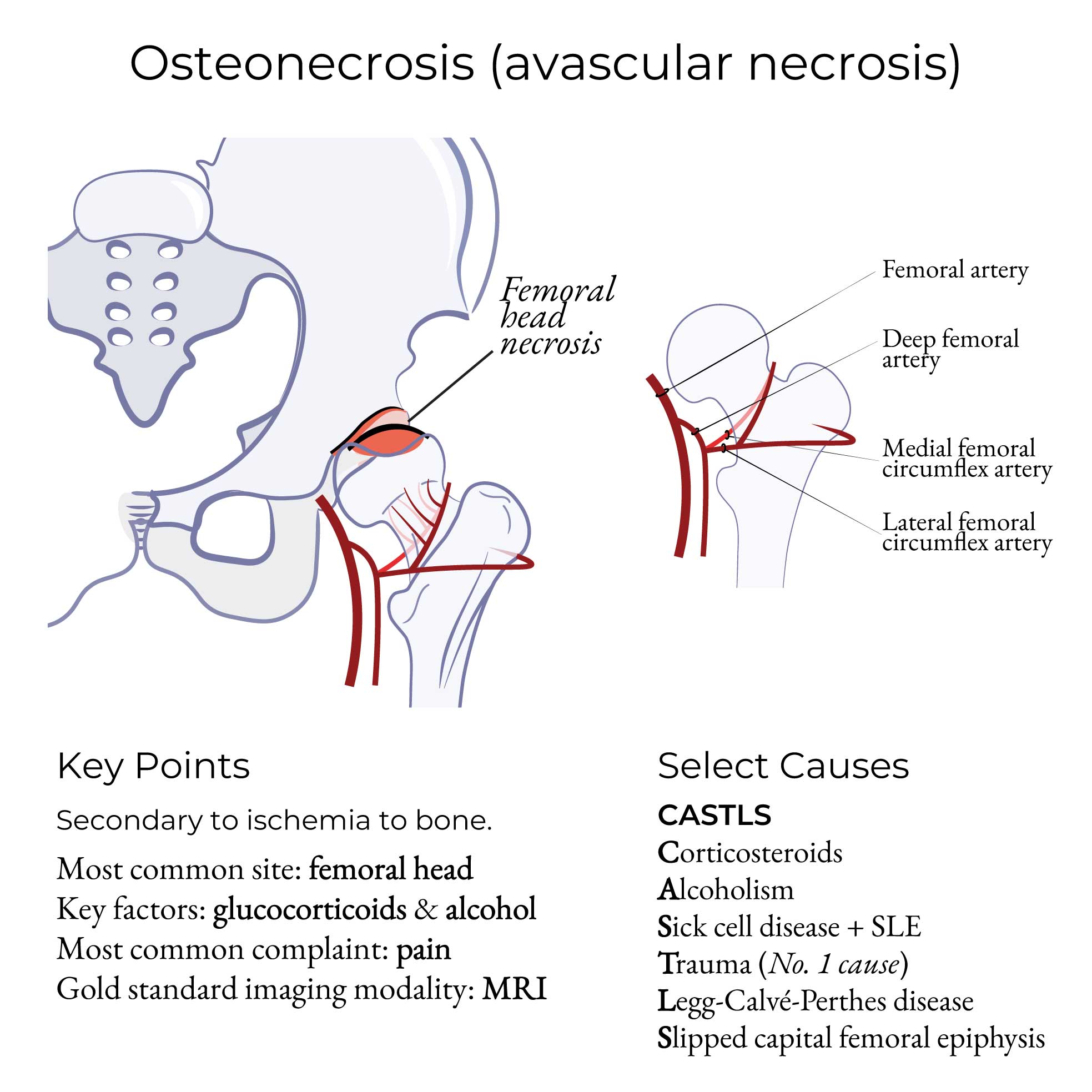 Osteonecrosis